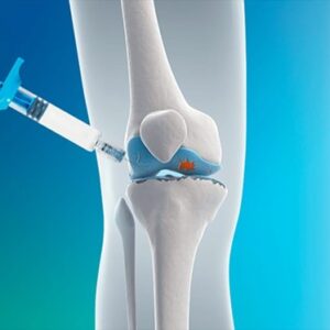 Ácido hialurônico para injetar nos joelhos depois de andar 40 km por dia